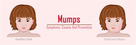 Mumps Symptoms Causes And Prevention