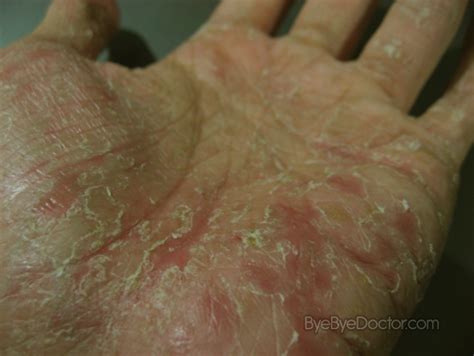 Dyshidrotic Eczema Pictures Causes Home Remedies Treatment