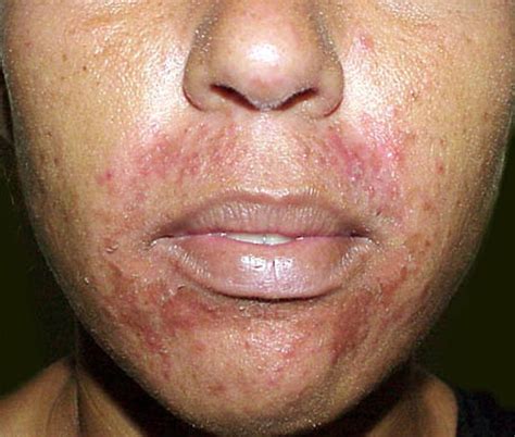 Pimples Around Mouth Pictures Photos