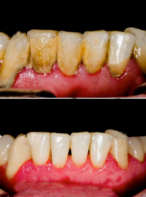 Teeth Scaling And Cleaning Positive Dental Belconnen