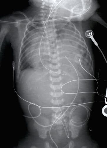 Hernia Diafragmatica Congenital Diaphragmatic Hernia