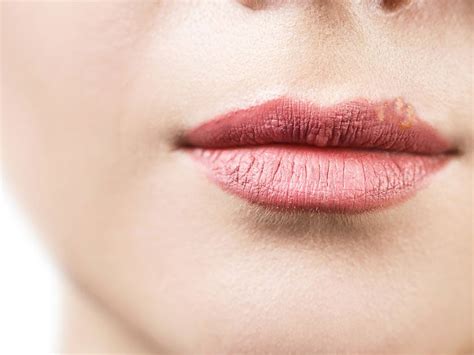 White Spots Around Your Lips Lipstutorial Org