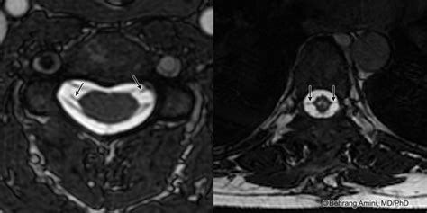 Roentgen Ray Reader Denticulate Ligaments