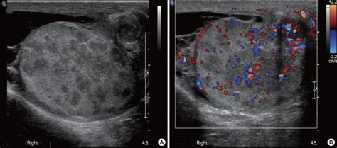 Ultrasonography Of Testis Showing Multiple Hypoechoic Lesions Inside