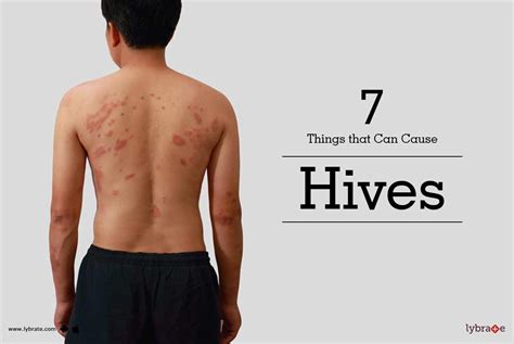 7 Things That Can Cause Hives By Dr Shivashankar B Sajjanshetty