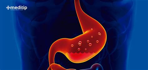 Reflujo Gastroesofágico Causas Diagnóstico Y Tratamiento Meditip