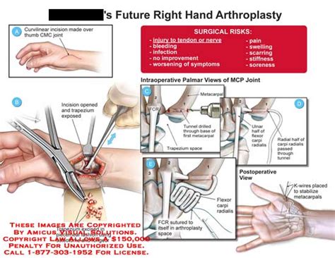 Amicus Illustration Of Amicus Surgery Hand Arthroplasty Curvilinear Cmc Joint Thumb Incision