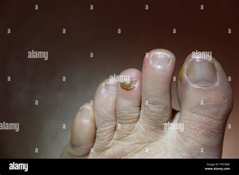 Toenail Hi Res Stock Photography And Images Alamy