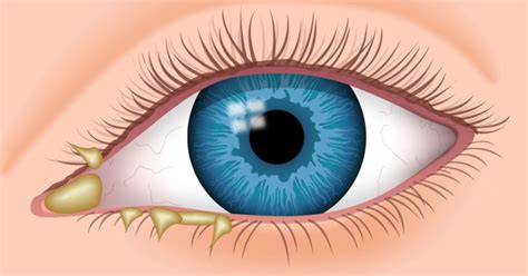 Secreción Ocular Causas Tipos Tratamiento