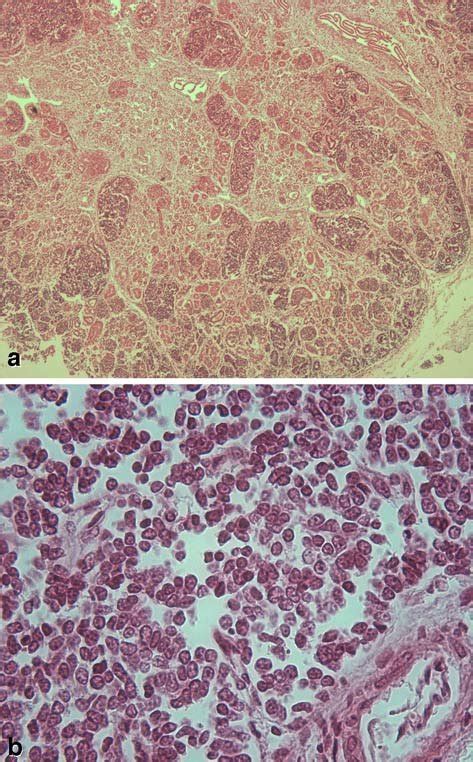 A Multiple Peri And Intralobar Nephrogenic Rests Which Are Partly Well
