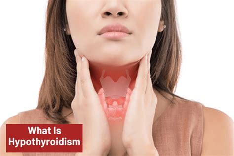 Hypothyroidism Diseases Symptoms Causes And Treatments