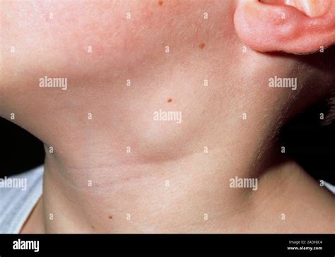 Swollen Glands Close Up Of A Swollen Lymph Node Gland In The Neck Of