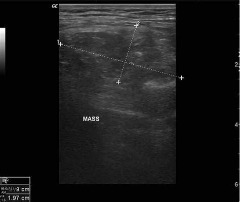 Lipoma Echocardiography Or Ultrasound Wikidoc