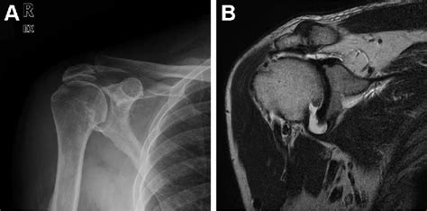 Figure 1 From Is Arthroscopic Distal Clavicle Resection Necessary For