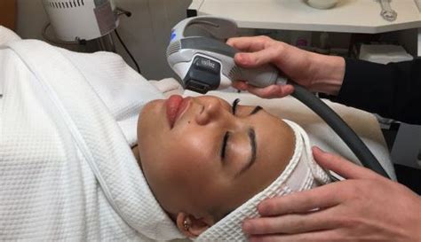 Isolaz The Best Laser Acne Treatment