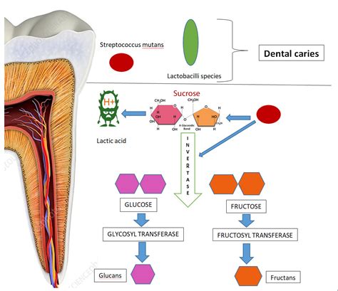 Dental Caries Focus Dentistry