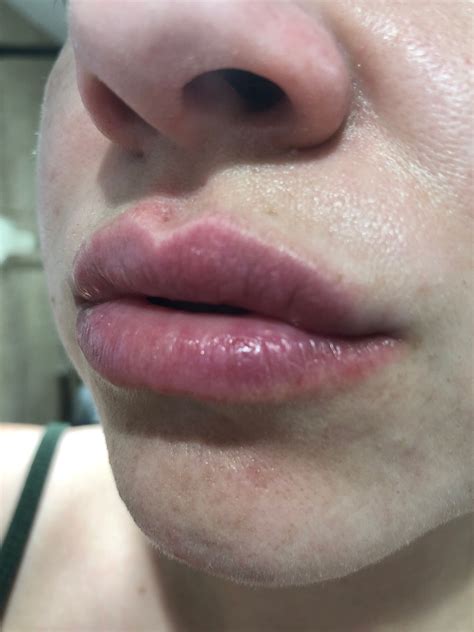 Pics Of Allergic Reaction On Lipstick