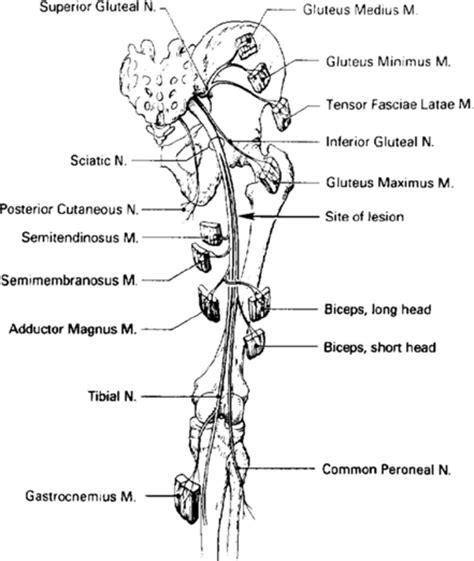Sciatic Nerve Entrapment In A Child In Journal Of Neurosurgery Volume