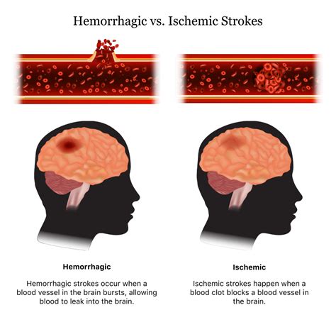 Which Of The Following Is Accurate Regarding A Hemorrhagic Stroke