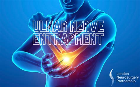 Ulnar Nerve Entrapment Pain Management Conditions