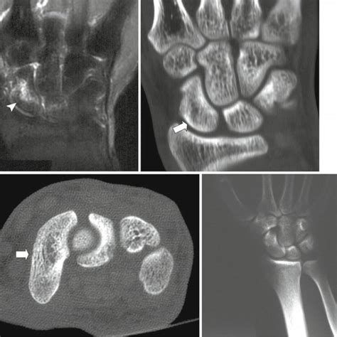 A Fat Suppressed Coronal T2 Weighted Mri Shows An Oblique Transverse