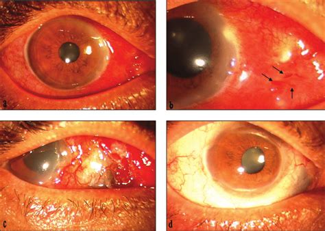 Slit Lamp Photographs Of The Patients Right Eye On Presentation