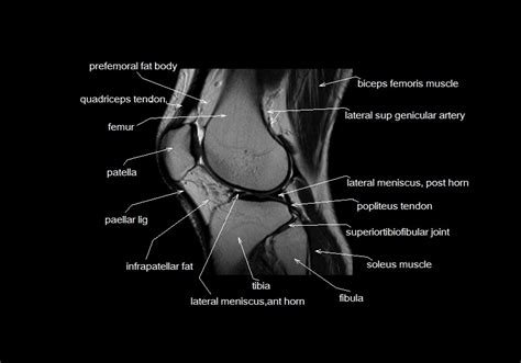 Structure, ligaments, bursae, movements & clinical anatomy of the knee joint. mri knee anatomy | knee sagittal anatomy | free cross ...