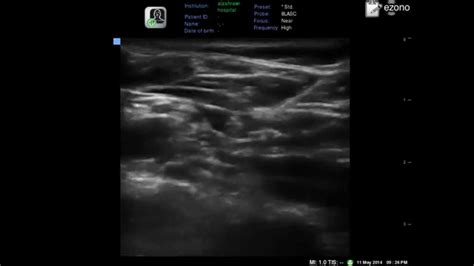Ultrasound Guided Supraclavicular Brachial Plexus Block In One Minute