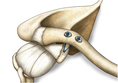 Delayed Acromioclavicular Joint Reconstruction Using A Modern