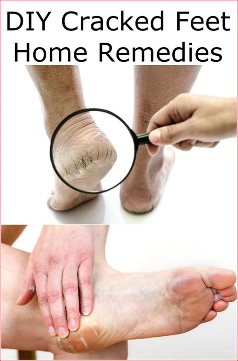 Diy Cracked Feet Home Remedies In 2020 Cracked Feet Home Remedies