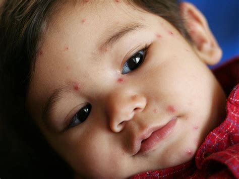 Tiny Red Dots On Skin Toddler