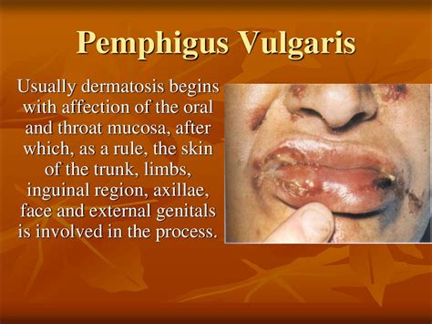 Bullous And Vesicular Dermatoses Online Presentation