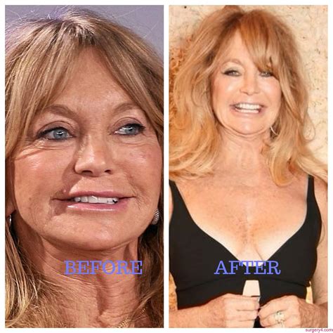 Goldie Hawn Plastic Surgery Photos Before And After Surgery4