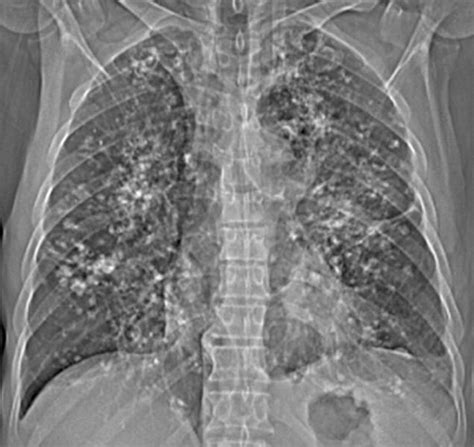 Pulmonary Amyloidosis With Calcified Nodules And Masses A Six Year