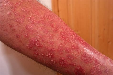 Diagnosis Spotlight Common Rashes And How To Treat Them Part 1