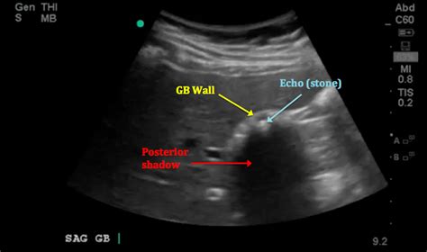 The Case Of The Disappearing Gallbladder — Temple Point Of Care Ultrasound