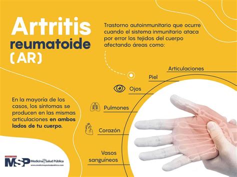 Artritis Reumatoide Medicina Y Salud P Blica