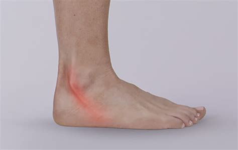 Peroneal Tendonitis Causes Symptoms Diagnosis Treatment And More