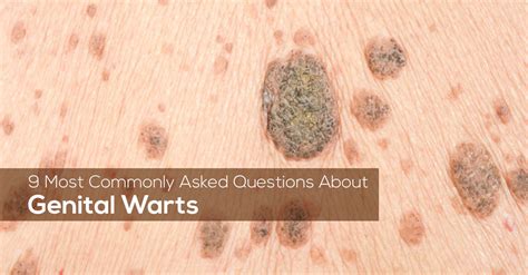9 Most Commonly Asked Questions About Genital Warts Marham