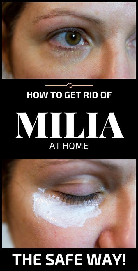 How To Get Rid Of Milia At Home The Safe Way Thebeautymania Net