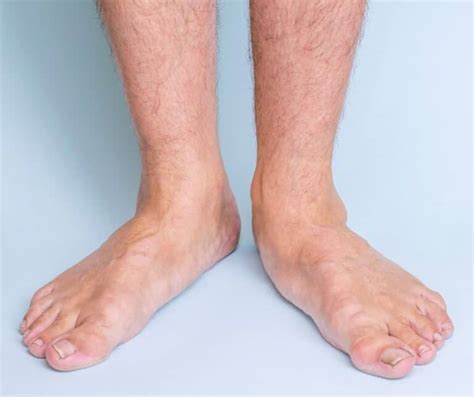 Flat Feet And High Arched Feet Things To Know Custom Rehab