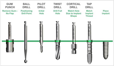 The Dentists Guide To Placing Implants In Simple Cases Dentistry Today