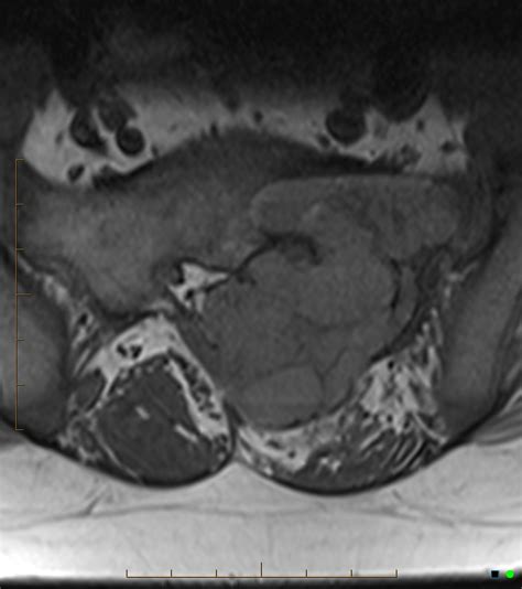 Aneurysmal Bone Cyst Sacrum Image