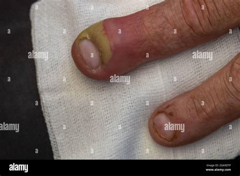Swollen Finger Of One Hand Due To Dermatologic Infection From A Pus