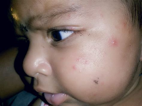 Hi My Baby Is In 3rd Monthmosquito Bites On Her Faceso Its Seeing