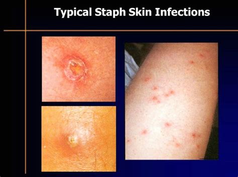 Minor Staphylococcus Infection