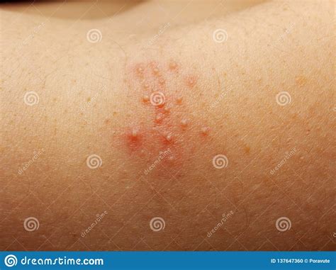 Rash And Other Nonspecific Skin Eruption Stock Photo Cartoondealer