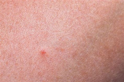 Tick Bite On The Arm Of A Woman Stock Image Image Of Body Irritated
