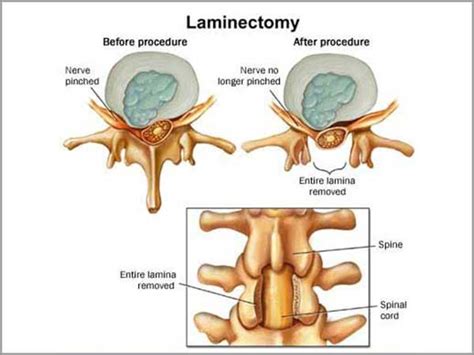 Laminectomy Disectomy Greenview Medical Center