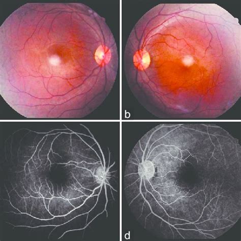 A And B Fundus Photograph Of The Right And Left Eyes Showing Normal